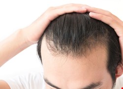 【性別重塑手術】髮線前移手術